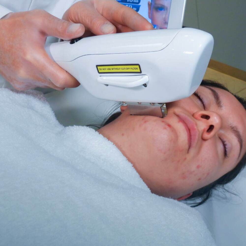 Trattamento luce pulsata (ipl).